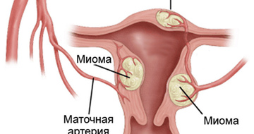 Фото: Что делать при миоме матки