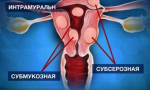 Фото:Субмукозная миома матки: симптомы