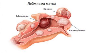 Фото:Лейомима матки