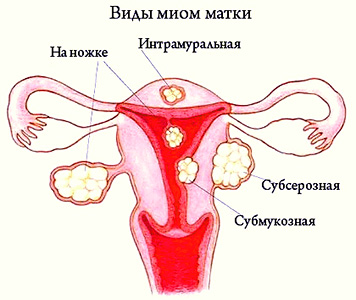 Фото:Субмукозная миома матки