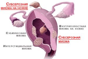 Фото:Субсерозная миома матки